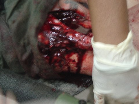 Self portrait of Big Daddy's leg after being hit with a 107-MM Mortar
